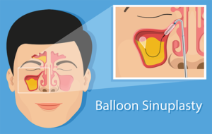 In-Office Balloon Sinuplasty for Chronic Sinusitis – Oregon Coast ...